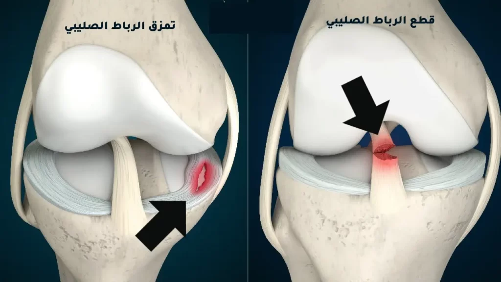 أعراض الرباط الصليبي